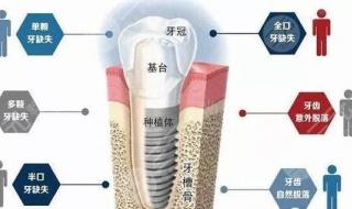 种牙一般要多少钱一颗